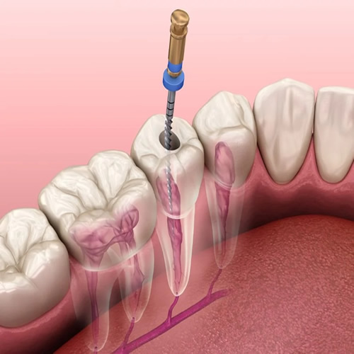 dental-implant-treatment-at-nawale-dentocare-aurangabad