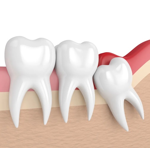 wisdom-tooth-treatment-at-nawale-dentocare-aurangabad