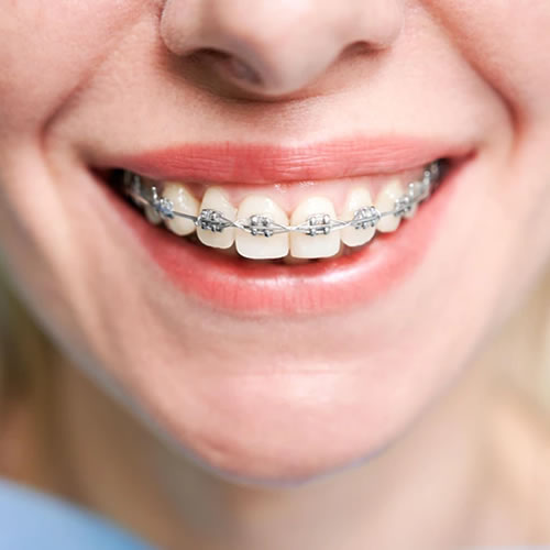 braces-treatment-at-nawale-dentocare-aurangabad