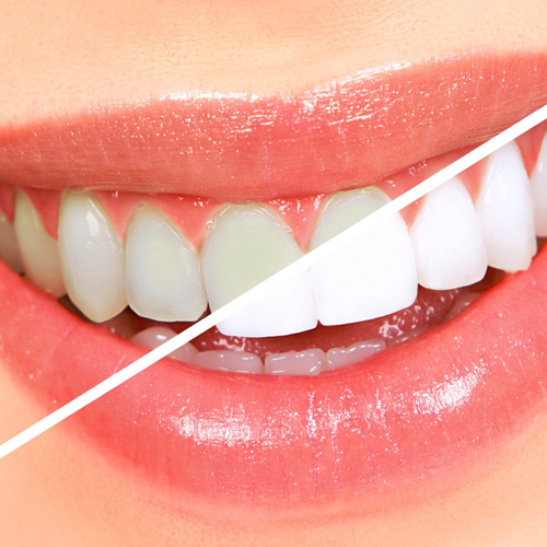 teeth-whitenings-treatment-at-nawale-dentocare-aurangabad