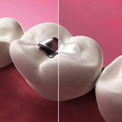 tooth-colour-fillingtreatment-at-nawale-dentocare-aurangabad