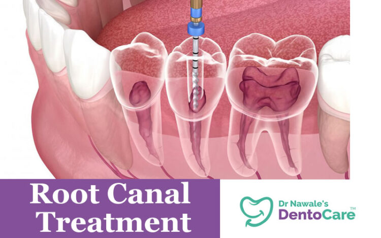 root canal treatment in Aurangabad | Dr Nitin Nawale root canal treatment expert in aurangabad | root canal expert in aurangabad