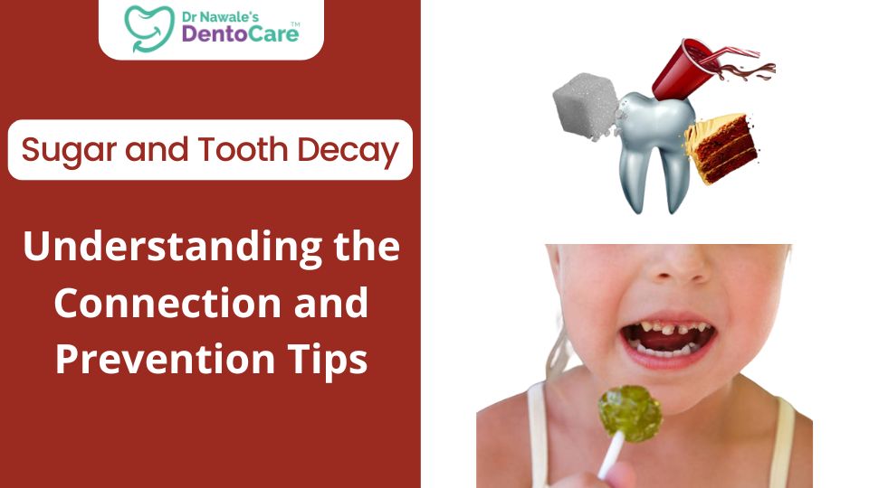 Sugar and Tooth Decay Understanding the Connection and Prevention Tips