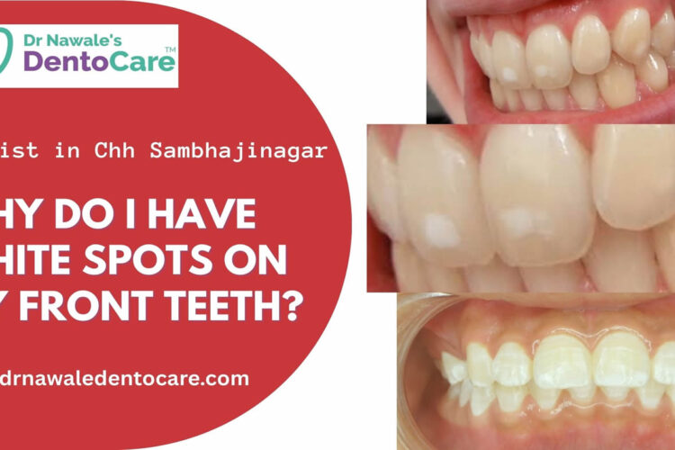 Why Do I Have White Spots on My Front Teeth Dentist in Chh Sambhajinagar Aurangabad