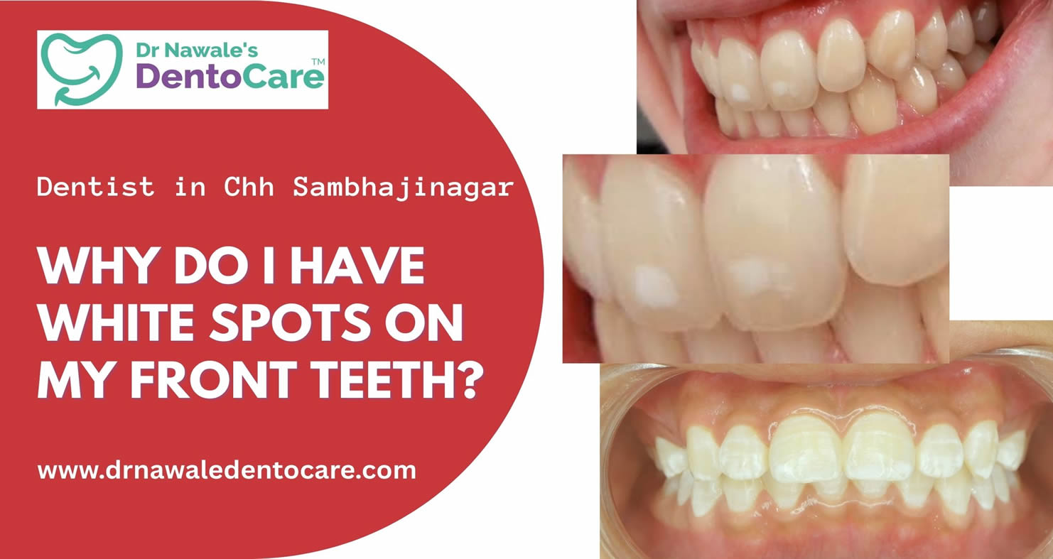 Why Do I Have White Spots on My Front Teeth Dentist in Chh Sambhajinagar Aurangabad