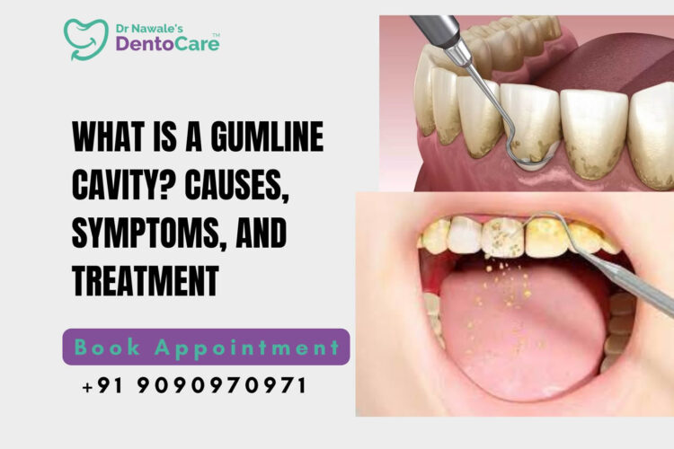 What is a Gumline Cavity? Causes, Symptoms, and Treatment - best dental clinic in chh sambhajinagar (aurangabad)