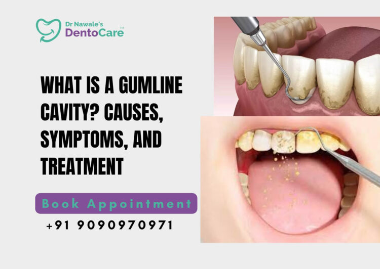 What is a Gumline Cavity? Causes, Symptoms, and Treatment - best dental clinic in chh sambhajinagar (aurangabad)