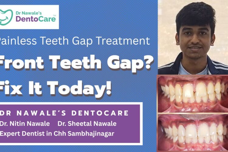 front teeth gap filling treatment in chh sambhajinagar