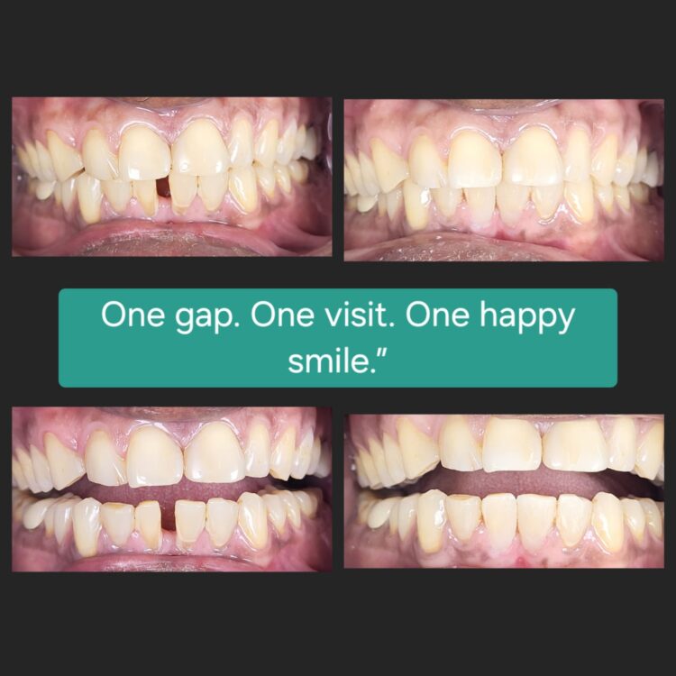 Best dental treatment by Dr. Nitin Nawale & Dr. Sheetal Nawale at Dr Nawale's DentoCare in Chh Sambhajinagar Aurangabad