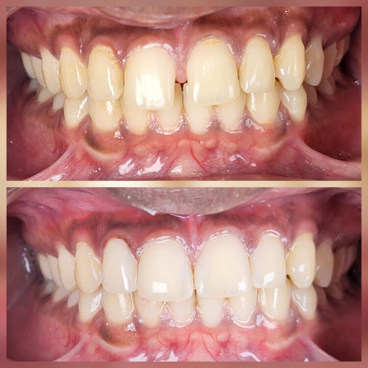 Best dental treatment by Dr. Nitin Nawale & Dr. Sheetal Nawale at Dr Nawale's DentoCare in Chh Sambhajinagar Aurangabad