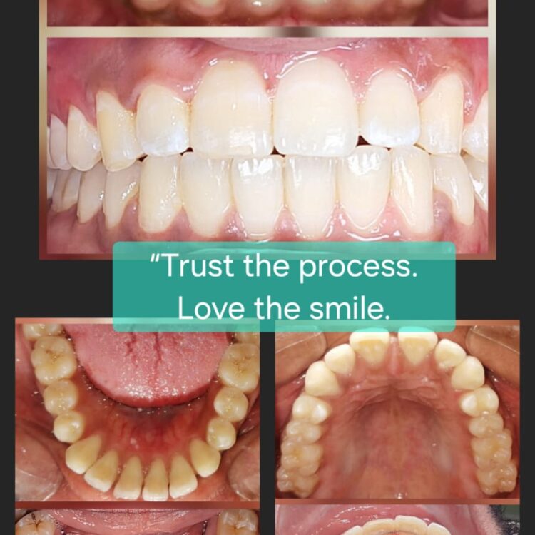 Best dental treatment by Dr. Nitin Nawale & Dr. Sheetal Nawale at Dr Nawale's DentoCare in Chh Sambhajinagar Aurangabad