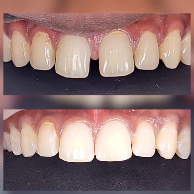 Best dental treatment by Dr. Nitin Nawale & Dr. Sheetal Nawale at Dr Nawale's DentoCare in Chh Sambhajinagar Aurangabad