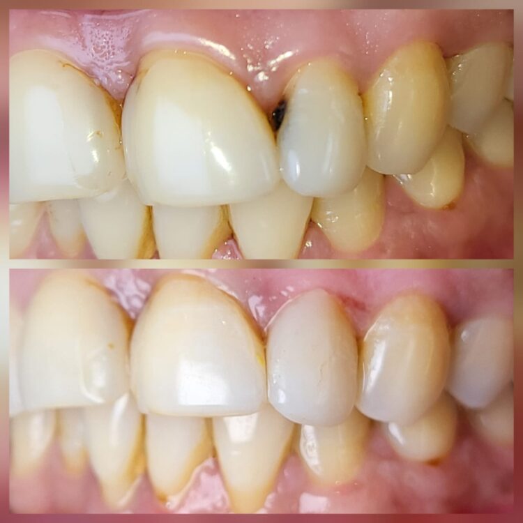 Best dental treatment by Dr. Nitin Nawale & Dr. Sheetal Nawale at Dr Nawale's DentoCare in Chh Sambhajinagar Aurangabad