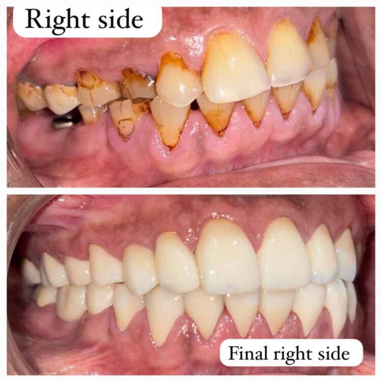 Best dental treatment by Dr. Nitin Nawale & Dr. Sheetal Nawale at Dr Nawale's DentoCare in Chh Sambhajinagar Aurangabad