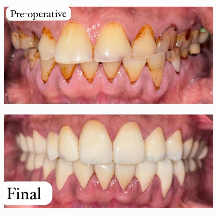 Best dental treatment by Dr. Nitin Nawale & Dr. Sheetal Nawale at Dr Nawale's DentoCare in Chh Sambhajinagar Aurangabad