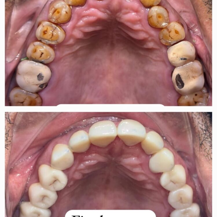 Best dental treatment by Dr. Nitin Nawale & Dr. Sheetal Nawale at Dr Nawale's DentoCare in Chh Sambhajinagar Aurangabad