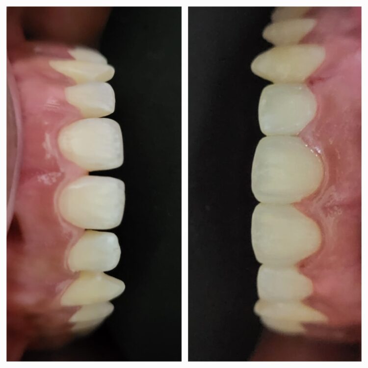 Best dental treatment by Dr. Nitin Nawale & Dr. Sheetal Nawale at Dr Nawale's DentoCare in Chh Sambhajinagar Aurangabad