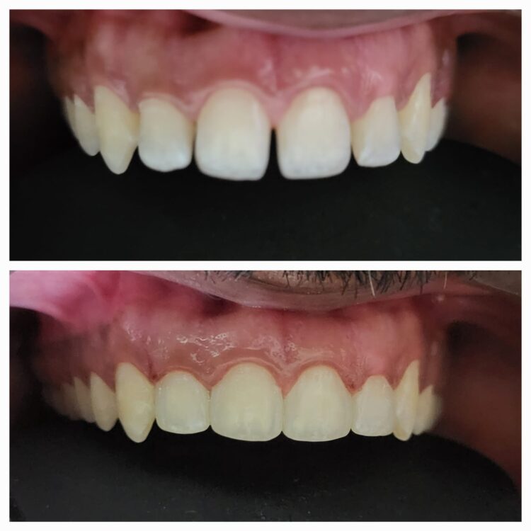 Best dental treatment by Dr. Nitin Nawale & Dr. Sheetal Nawale at Dr Nawale's DentoCare in Chh Sambhajinagar Aurangabad