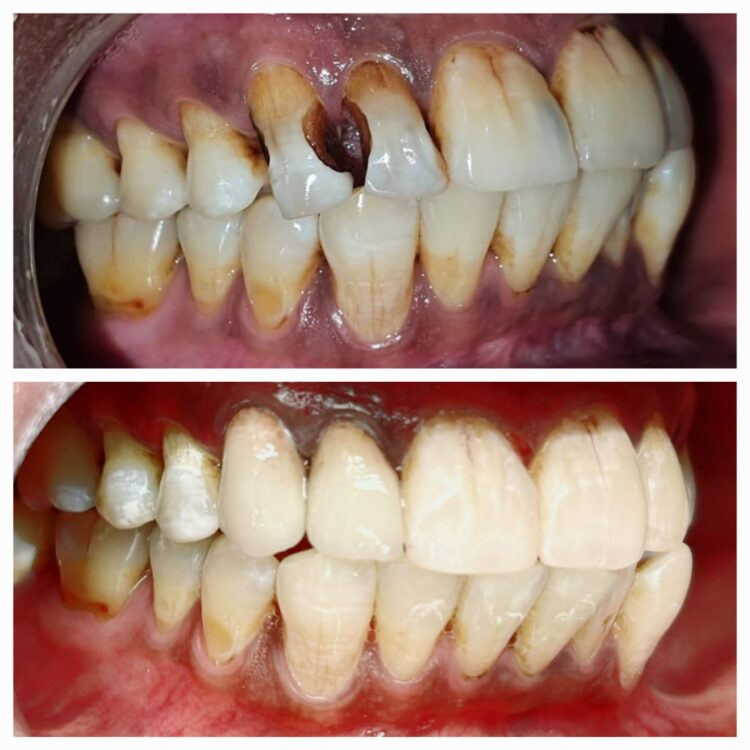 Best dental treatment by Dr. Nitin Nawale & Dr. Sheetal Nawale at Dr Nawale's DentoCare in Chh Sambhajinagar Aurangabad