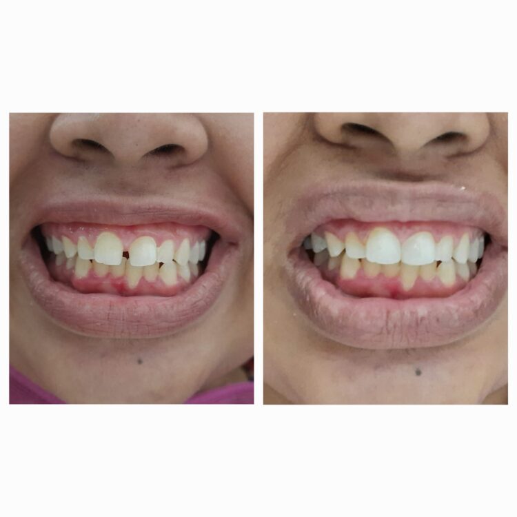 Best dental treatment by Dr. Nitin Nawale & Dr. Sheetal Nawale at Dr Nawale's DentoCare in Chh Sambhajinagar Aurangabad