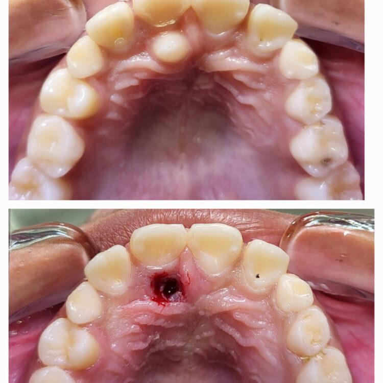 Best dental treatment by Dr. Nitin Nawale & Dr. Sheetal Nawale at Dr Nawale's DentoCare in Chh Sambhajinagar Aurangabad