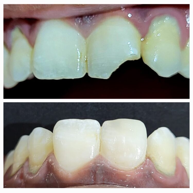 Best dental treatment by Dr. Nitin Nawale & Dr. Sheetal Nawale at Dr Nawale's DentoCare in Chh Sambhajinagar Aurangabad