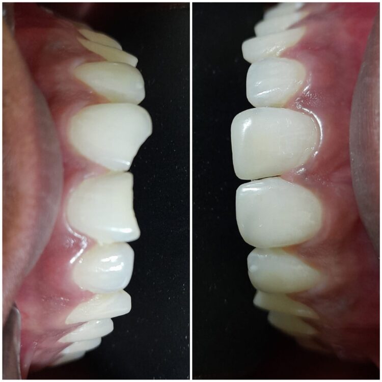 Best dental treatment by Dr. Nitin Nawale & Dr. Sheetal Nawale at Dr Nawale's DentoCare in Chh Sambhajinagar Aurangabad