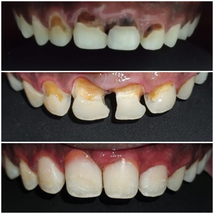 Best dental treatment by Dr. Nitin Nawale & Dr. Sheetal Nawale at Dr Nawale's DentoCare in Chh Sambhajinagar Aurangabad