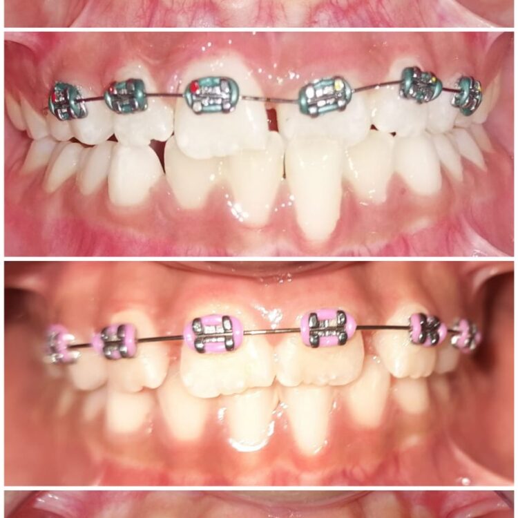 Best dental treatment by Dr. Nitin Nawale & Dr. Sheetal Nawale at Dr Nawale's DentoCare in Chh Sambhajinagar Aurangabad