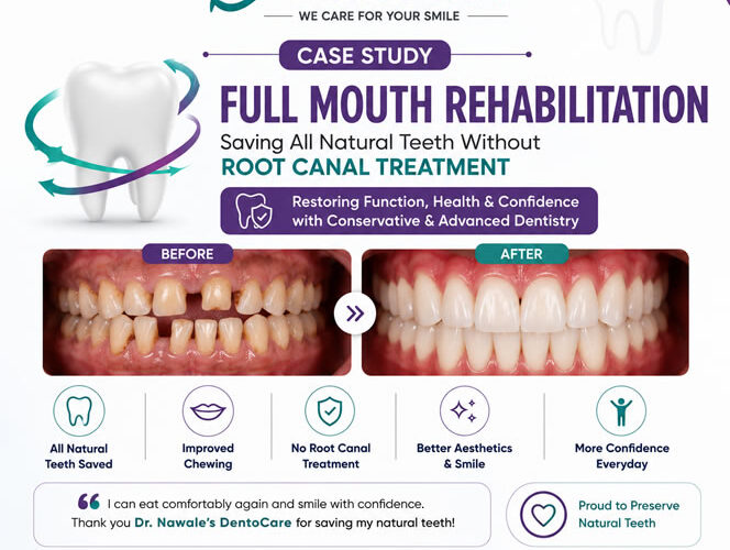 Full Mouth Rehabilitation Case Study – Saving All Natural Teeth Without Root Canal Treatment at Dr. Nawale's DentoCare, Chhatrapati Sambhajinagar