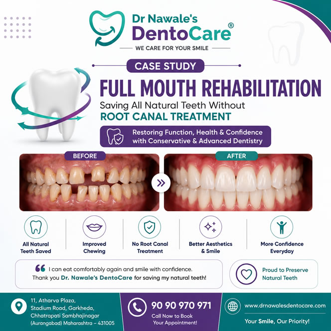 Full Mouth Rehabilitation Case Study – Saving All Natural Teeth Without Root Canal Treatment at Dr. Nawale's DentoCare, Chhatrapati Sambhajinagar